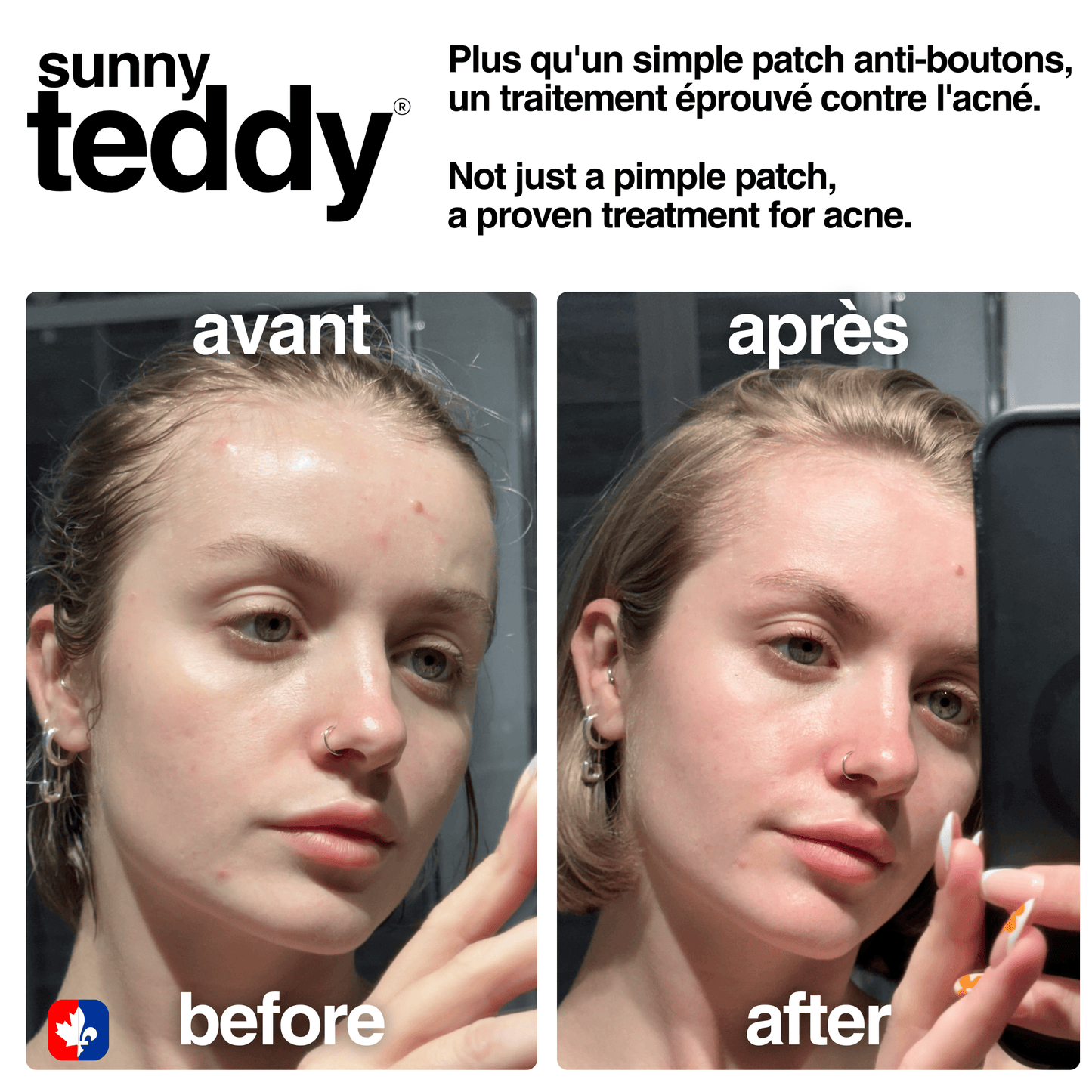 Pimple Patches with Salicylic Acid - 72 Pink Teddies