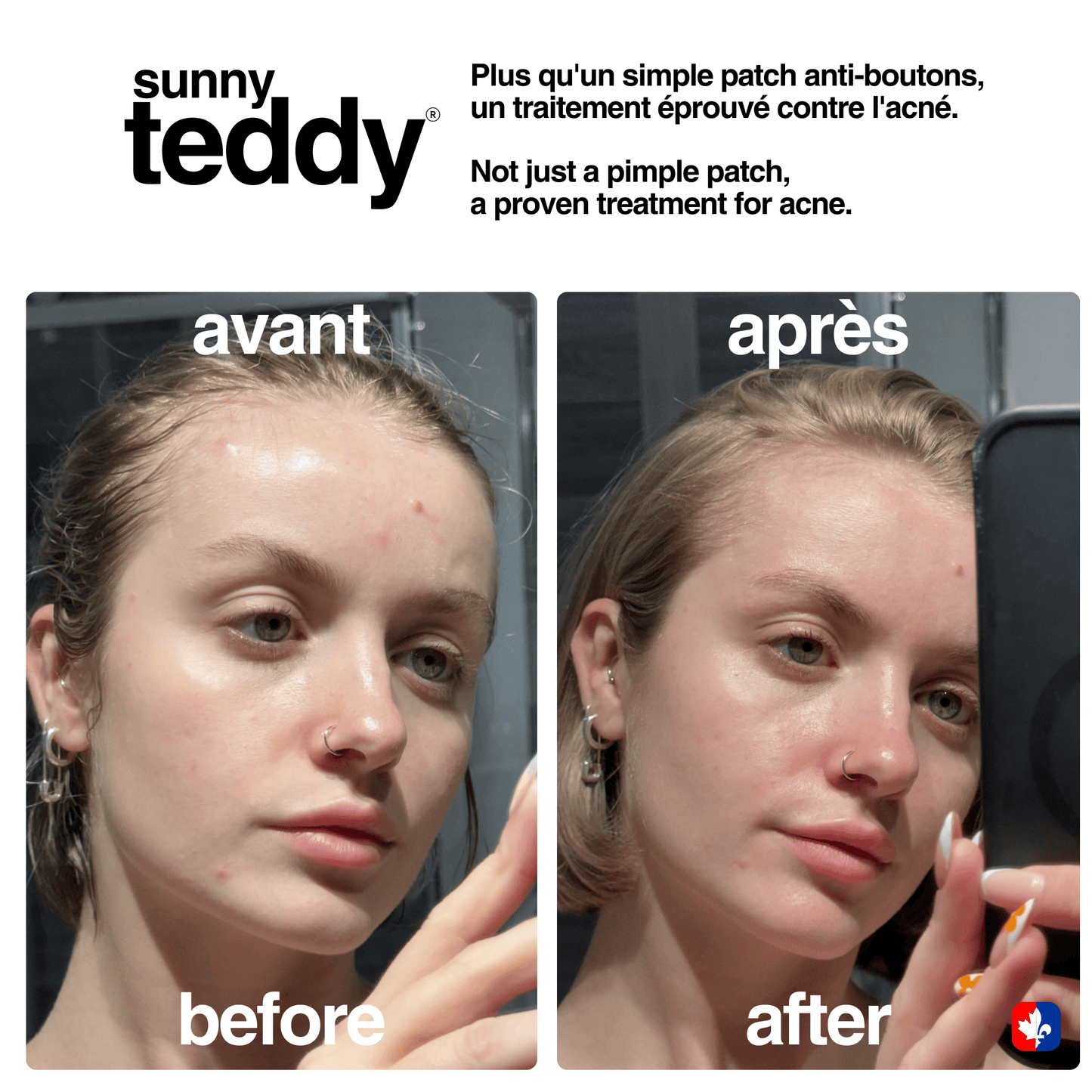 Sunny Teddy Discovery Pack - 108 Salicylic Patches