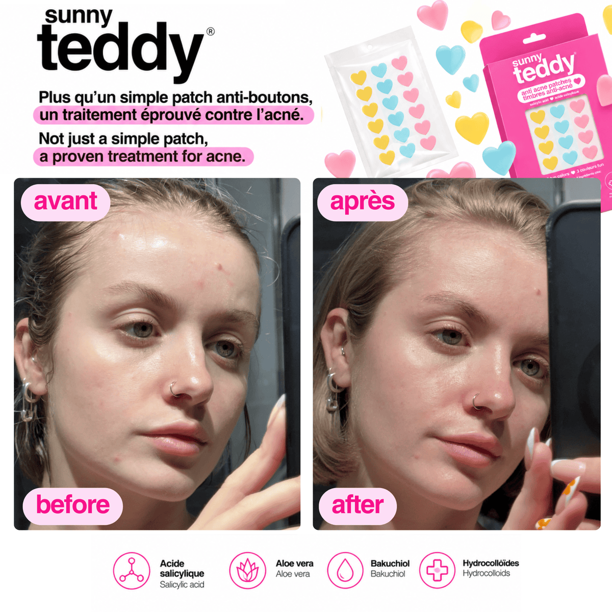 Sunny Teddy Pimple Patches - 72 Multicolor Hearts