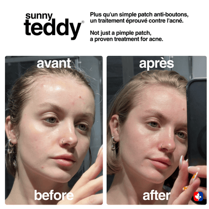 Sunny Teddy Pimple Patches - 36 Pink Stars