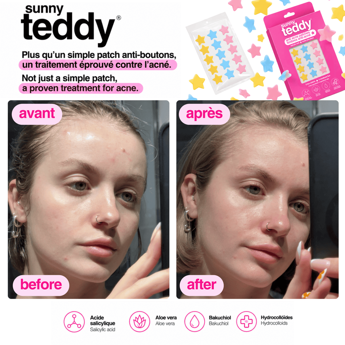 Sunny Teddy Pimple Patches - 72 Multicolor Stars